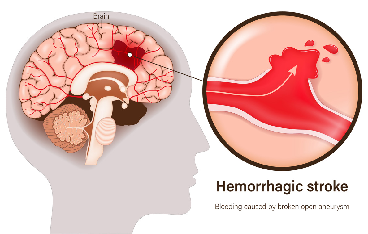 Graphic of Hemorrhagic Stroke
